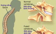 Cần biết về bệnh viêm cột sống dính khớp