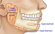 Viêm tuyến nước bọt