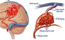 Dị dạng mạch máu dạng hang