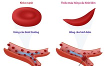 Bệnh thiếu máu hồng cầu hình liềm ở trẻ nhỏ