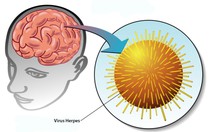 Bệnh viêm não do virus Herpes simplex