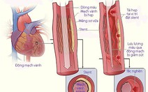 Tái hẹp sau nong mạch và đặt stent