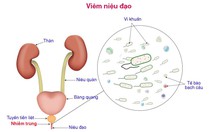 Viêm niệu đạo