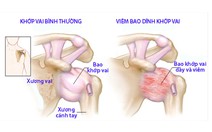 Viêm bao dính khớp vai