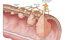 Điều trị và theo dõi ung thư đại trực tràng tránh tái phát