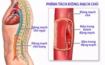 Bệnh phình tách thành động mạch chủ