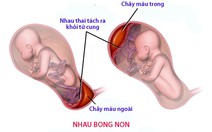 Tình trạng chảy máu khi mang thai