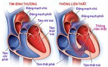 Dị tật thông liên thất