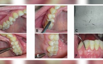 Mắc bệnh lạ, người phụ nữ mọc lông ở… lợi