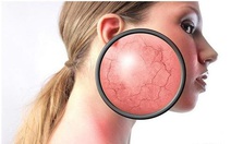 Sử dụng thuốc ngoài da chứa Corticoid liệu có ‘thần thánh’ như bạn nghĩ?