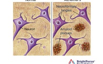 Nghiên cứu mới: Nhiễm vi rút dễ bị bệnh thoái hóa thần kinh