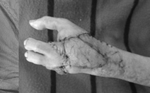 Phẫu thuật chuyển ngón chân thành ngón tay cho bệnh nhân bị máy xay thịt cuốn nát