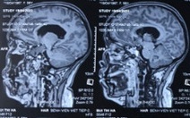 Tưởng bị thiếu máu não, đi khám phát hiện u màng não lớn
