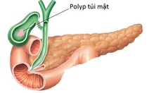 Chủ quan polyp túi mật lành tính, cẩn thận nguy hiểm