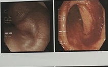 Trẻ em tiêu ra máu, cảnh báo polyp đại tràng