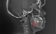 Bệnh nhân phản ánh nhổ răng khôn để ‘quên’ mũi khoan, bệnh viện nói gì?