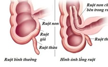 Bệnh viện quốc tế Tâm Trí Hồng Ngự cấp cứu lồng ruột trẻ em bằng kỹ thuật bơm hơi