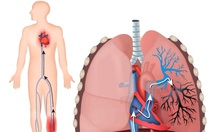 Cứu sống thai phụ ngừng tim do thuyên tắc phổi cấp, cận 'cửa tử'