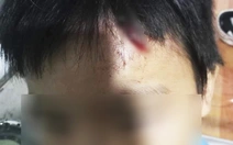 Bé trai bị mẹ kế đánh bể đầu