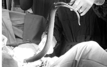 Suýt 'mất mạng' vì nhét con lươn sống, quả chanh vào hậu môn