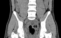 Cậu bé 14 tuổi bị liệt hai chân do đứt tủy sống sau tai nạn giao thông