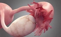 Phát hiện mới giúp nâng cao chẩn đoán và điều trị ung thư buồng trứng