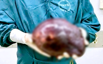 Cắt khối u gan khổng lồ nặng 2,5kg