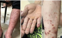 5 bệnh da liễu thường gặp trong mùa mưa lũ và cách xử lý