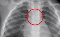 Kim chọc tủy dài 22 mm rơi vào đường thở bé trai 3 tuổi khi làm răng