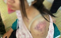 Bé gái bị bà nội, ông dượng và anh trai bà nội đánh đập dã man