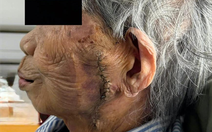 Phẫu thuật cắt bỏ khối ung thư lớn trên mặt cụ bà 99 tuổi