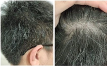 Có phải ‘tóc bạc nhiều là dấu hiệu của ung thư’?