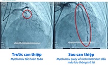 Bệnh viện Tâm Trí Cao Lãnh cứu sống 5 ca nhồi máu cơ tim cấp trong giờ vàng