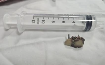 Bỗng dưng mất 2 chiếc răng, 20 năm sau bác sĩ phát hiện trong... phổi