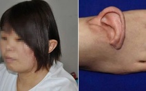 Ca phẫu thuật chưa từng có trên thế giới: Ghép tai bị đứt lên bàn chân rồi đưa về chỗ cũ