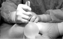 Cô gái bị biến dạng ‘vòng 1’ sau khi tiêm filler HA nâng ngực