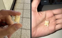 Ảnh vui 3-12: Chiếc răng khôn biết... nhảy chân sáo