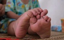 TP.HCM: Tác nhân EV71 tái xuất, ca mắc tay chân miệng nặng tăng