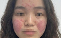 Cô gái trẻ đỏ rát mặt vì ô nhiễm không khí, bác sĩ hướng dẫn cách bảo vệ da