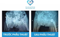 Gần 100 tuổi có thay khớp háng được không?