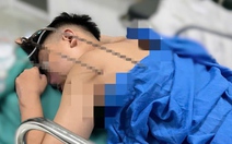 Cấp cứu nam thiếu niên bị đinh ba tự chế đâm thấu tim