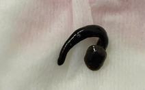 Đỉa suối 5cm ký sinh trong đường thở em bé 3 tuổi