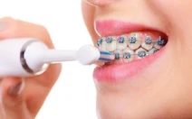 Ăn gì, vệ sinh răng thế nào khi đang niềng răng?