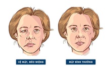 Nhiễm lạnh, trúng gió: Nguy cơ dẫn đến liệt dây thần kinh số 7 ngoại biên