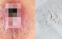 Phát hiện một ca mắc giun rồng, loại ký sinh trùng hiếm gặp dài hàng mét