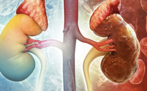 18 tuổi đã bị hỏng thận vì thói quen ăn uống