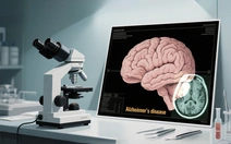 Trung Quốc đình chỉ phương pháp phẫu thuật điều trị Alzheimer phổ biến