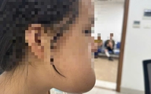 9 giờ liền phẫu thuật miễn phí cho thiếu nữ bị khối u khủng trên mặt