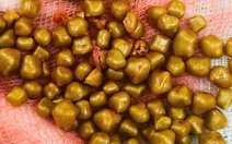 Mổ cấp cứu nữ bệnh nhân có hơn 100 viên sỏi chứa đầy trong túi mật