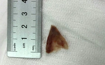 Mắc xương ngại đi bệnh viện, người phụ nữ dùng cách 'vuốt ngược'